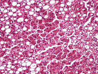 fatty liver